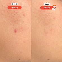 Charger l'image dans la galerie, Patchs Stop-Boutons
